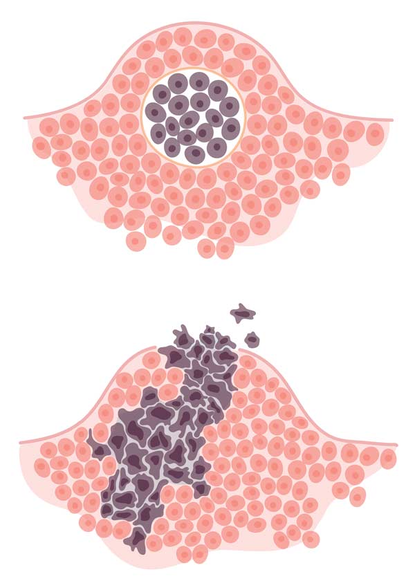 Comparison of benign and malignant tumours in dogs